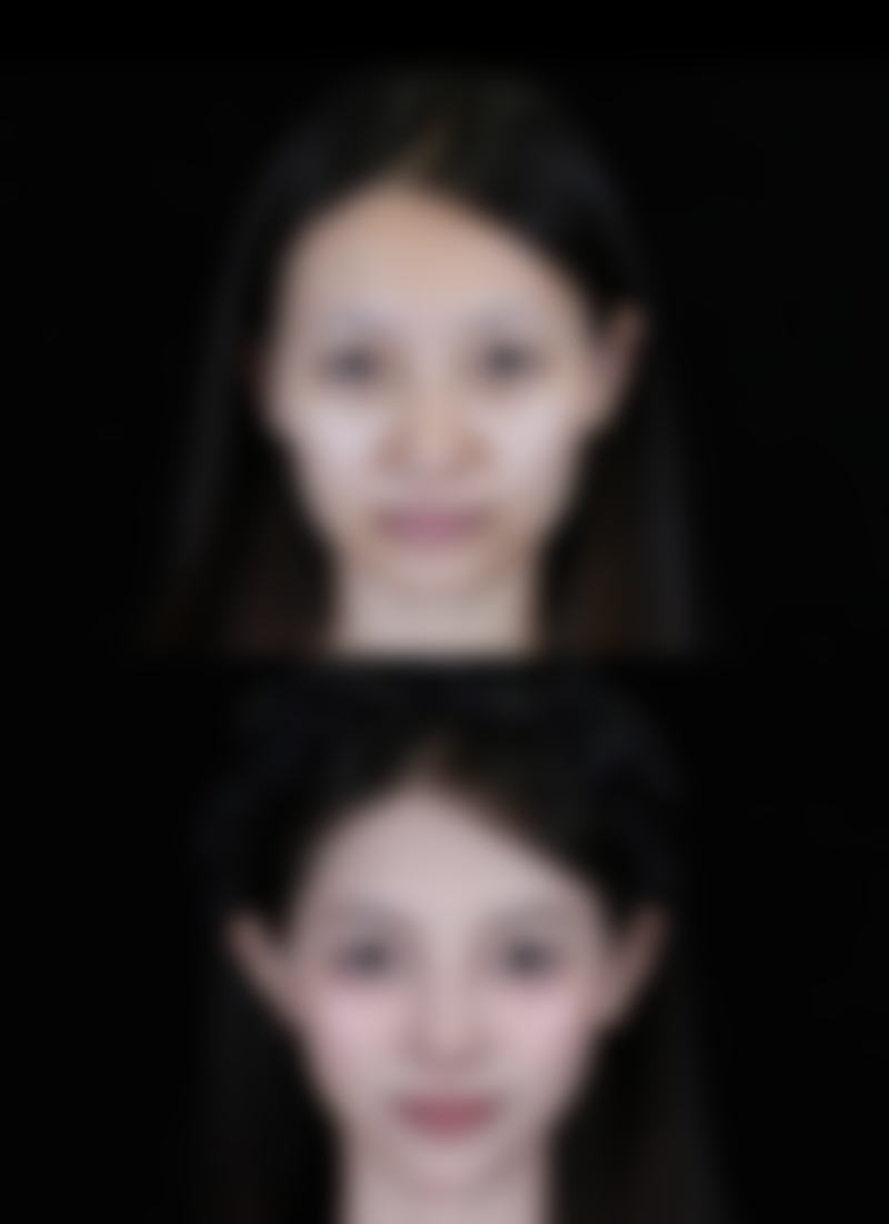 骨干医生不推荐下生姜敷眼袋的正确方法