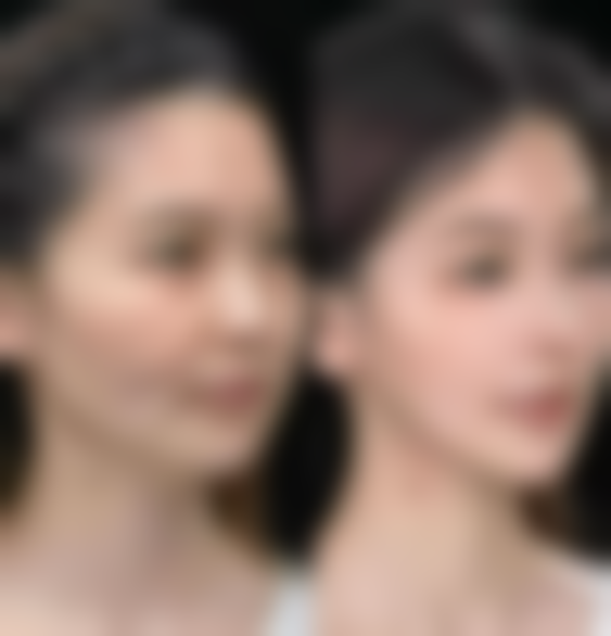 北京协和医院解析生姜敷眼袋的实际成效