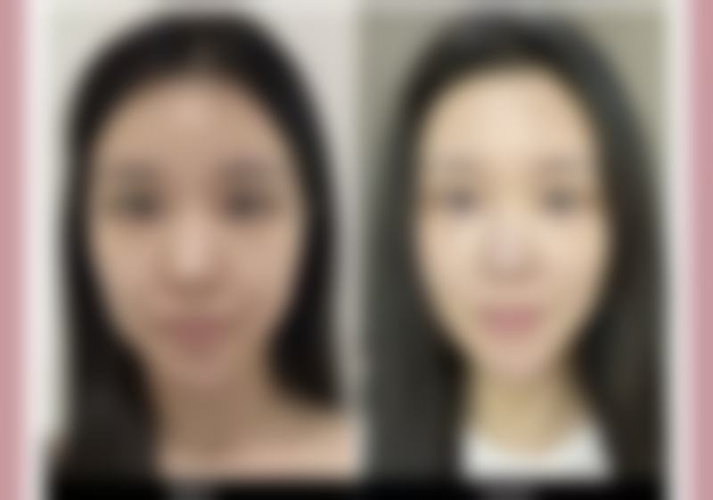 假体隆胸手术会死吗——手术操作不当的致命后果