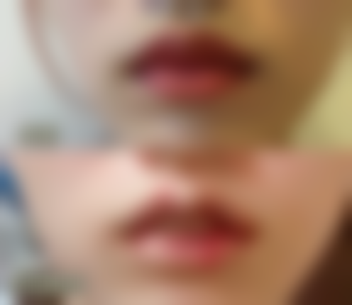 疤痕疙瘩会慢慢的自己消退吗？不治疗的潜在风险不容忽视