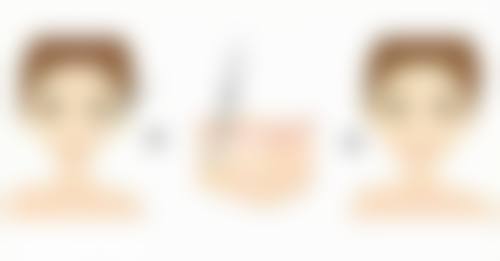 打保妥适瘦脸针多少天：修复时间大揭秘