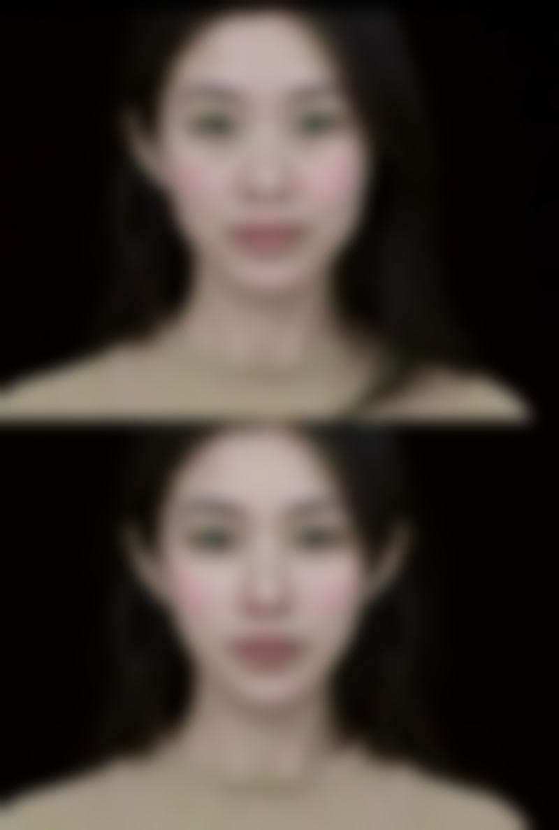 专精医院评判自体软骨隆鼻一次能保持多久