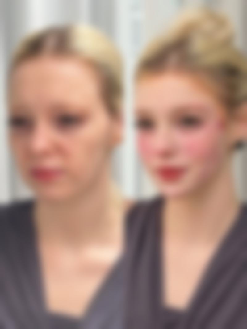 疤痕疙瘩会慢慢的自己消退吗？医学数据告诉你真相