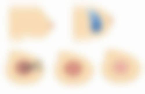 假体隆胸260是多大适合的人群画像：这些人做完笑到合不拢嘴