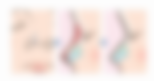 祛痣疤痕修复时间：不同祛痣方法的精细解读