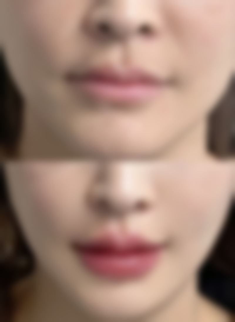 假体隆胸260是多大的避坑指南：当260cc遇到这些情况...