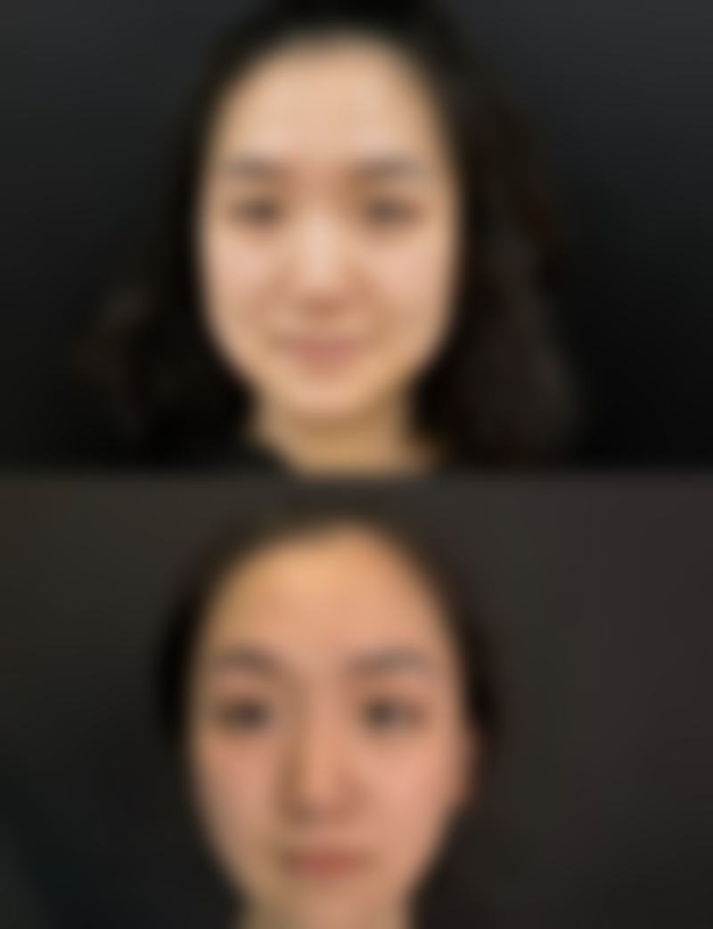 耳软骨复合隆鼻什么意思？原理+优势+恢复期全解析，2-5万就能get自然鼻！