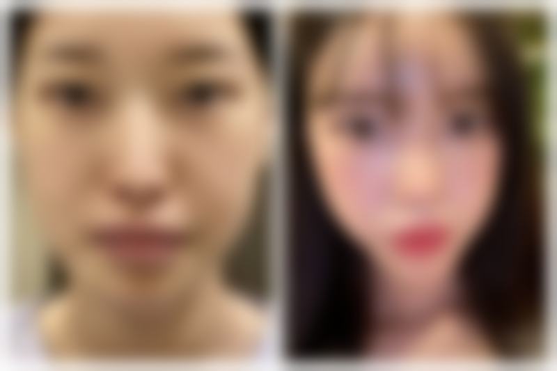 参军身体有手术疤痕可以吗？腹部、腿部疤痕这样处理就能过体检！