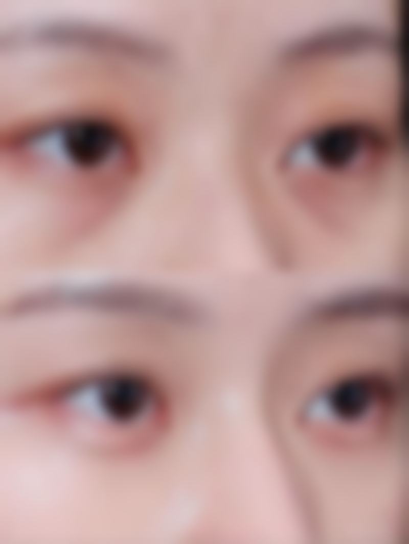 全切双眼皮红色线长时间不消失怎么办：应对策略