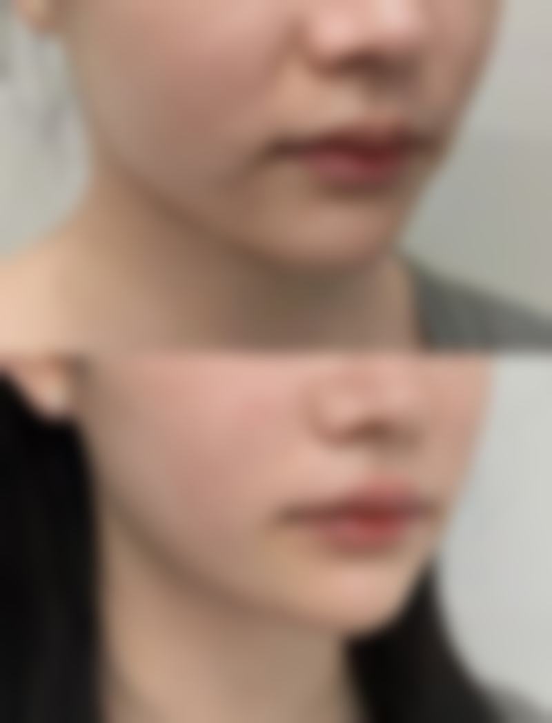 加快全切双眼皮红色线消失的6个实用方法：助力修复