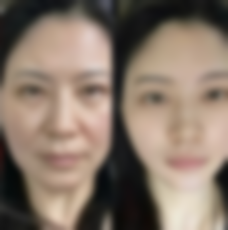 疤痕性青春痘如何治疗：饮食辅助治疗——吃出来的光滑肌肤