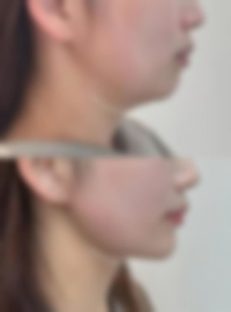 疤痕性青春痘如何治疗：手术治疗——重度疤痕的终极解决方案