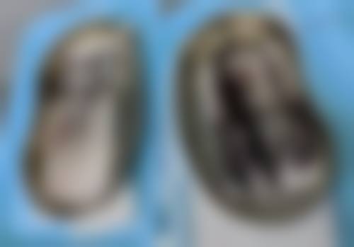 北京上海精尖医院埋线成效大比拼