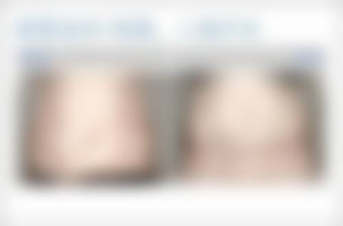 小腿抽脂其他风险与后遗症的应对