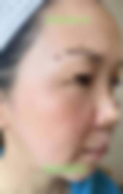 厦门大学附属翔安医院烧伤整形外科口碑好不好？附真实患者口碑评价