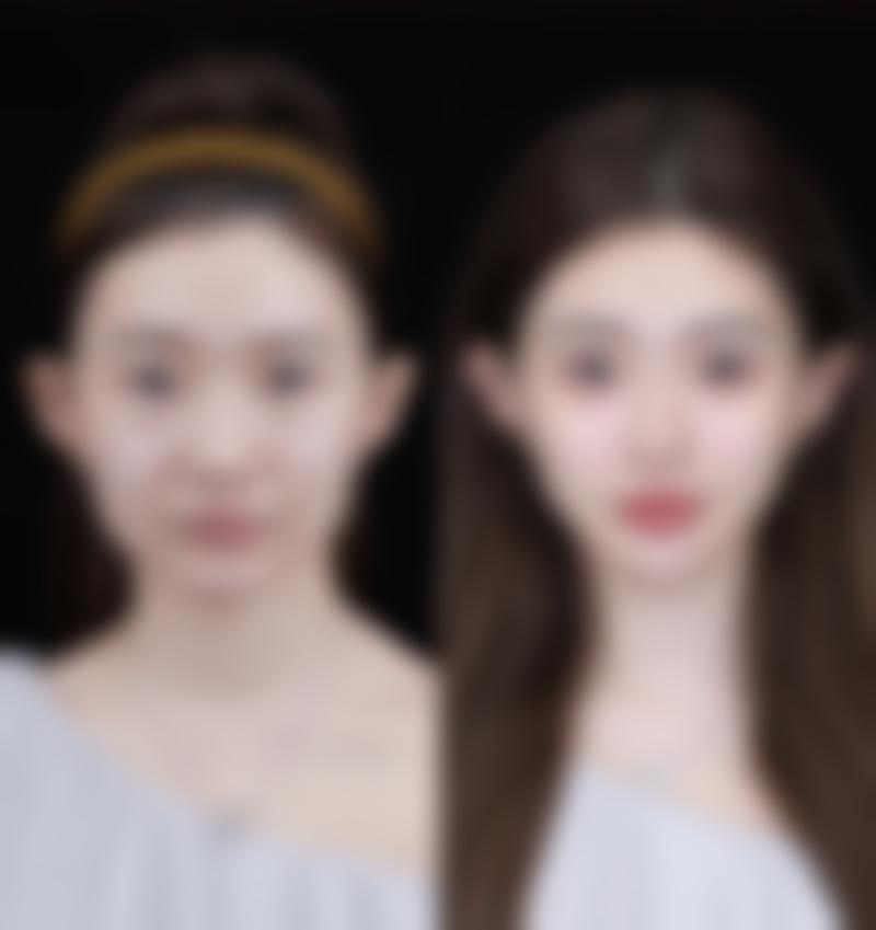 小腿抽脂脂肪栓塞与医生技术和术前评估