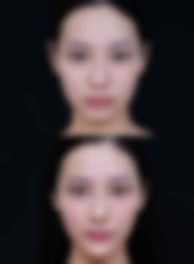 埋线与全切：哪种双眼皮手术更适合你