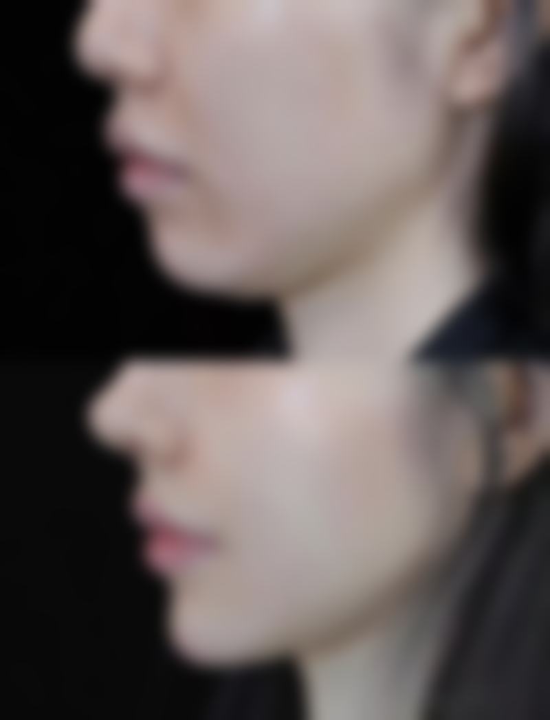 术后修复攻略：从“肿泡眼”到“电眼”的华丽蜕变