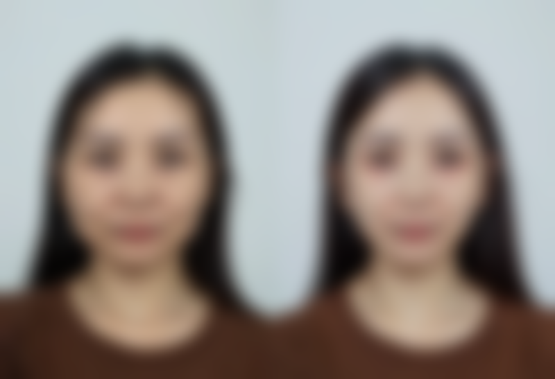 抽脂手术有危险吗——麻醉的风险与选择