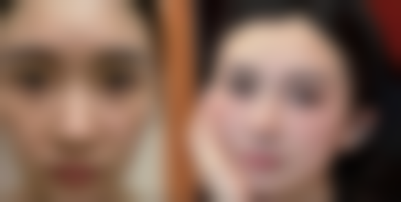 身体肥胖可以抽脂吗？局部和产后肥胖需谨慎，医生建议先健康减重