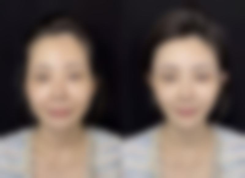 怎么修复疤痕日常护理成效好：小贴士助力修复