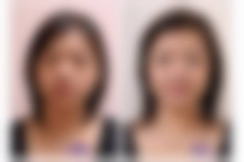 注射骨粉隆鼻有什么副作用——远期隐患：时间考验下，鼻子问题频出修复难