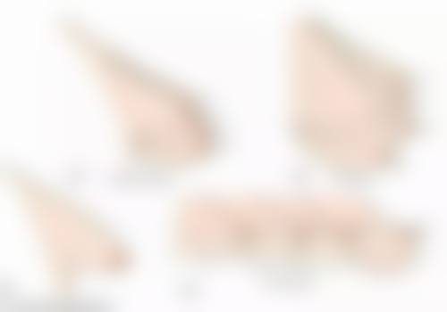 做脸部吸脂效果好不好，三甲医院VS专业整形医院真实对比，选对医生效果翻倍