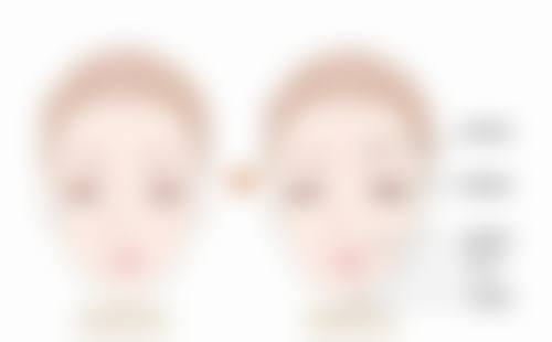 怎么有效去除黑眼袋之医美治疗专精解决方案