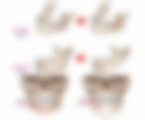 注射骨粉隆鼻有什么副作用——组织坏死：从注射点到皮肤溃烂的“恐怖连锁反应”