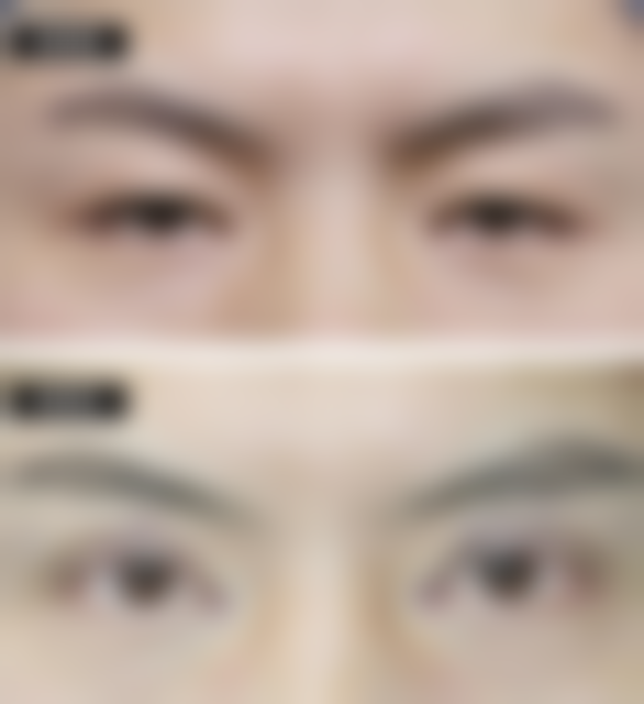 注射骨粉隆鼻有什么副作用——排异反应：免疫系统疯狂反击，骨粉成“入侵者”