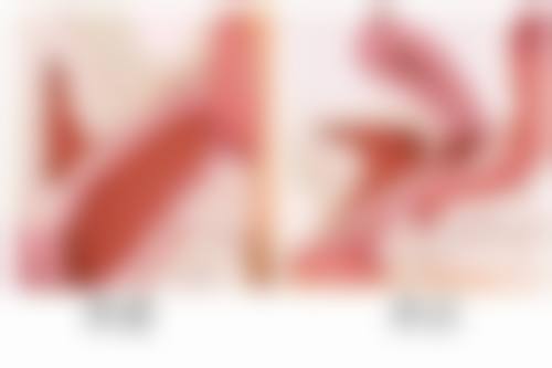 全切双眼皮切眼袋消肿之个人体质差异