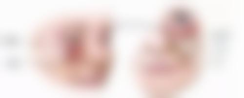 割埋线双眼皮多久能翻白眼：快速修复的优势体现