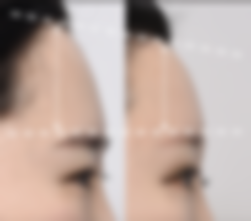 专精医生传授疤痕体质安心祛痣第一招：选对方法