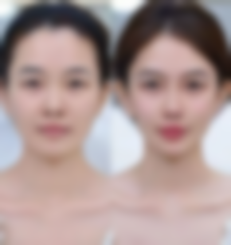 多少岁可以抽脂吗之未成年人的慎重选择