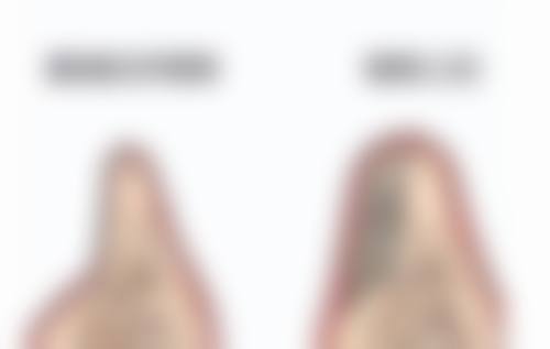 如何才能消掉疤痕体质之手术治疗：医院提供的终极解决方案