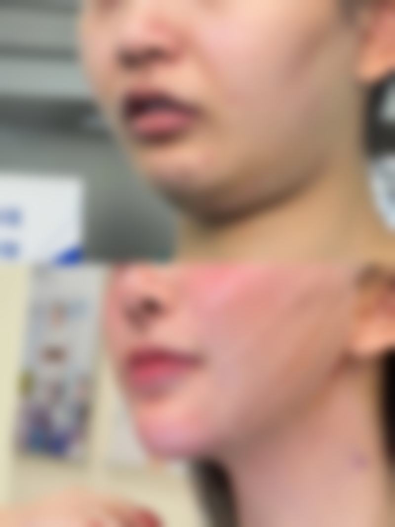 隆胸假体取出会有什么后果之组织粘连风险