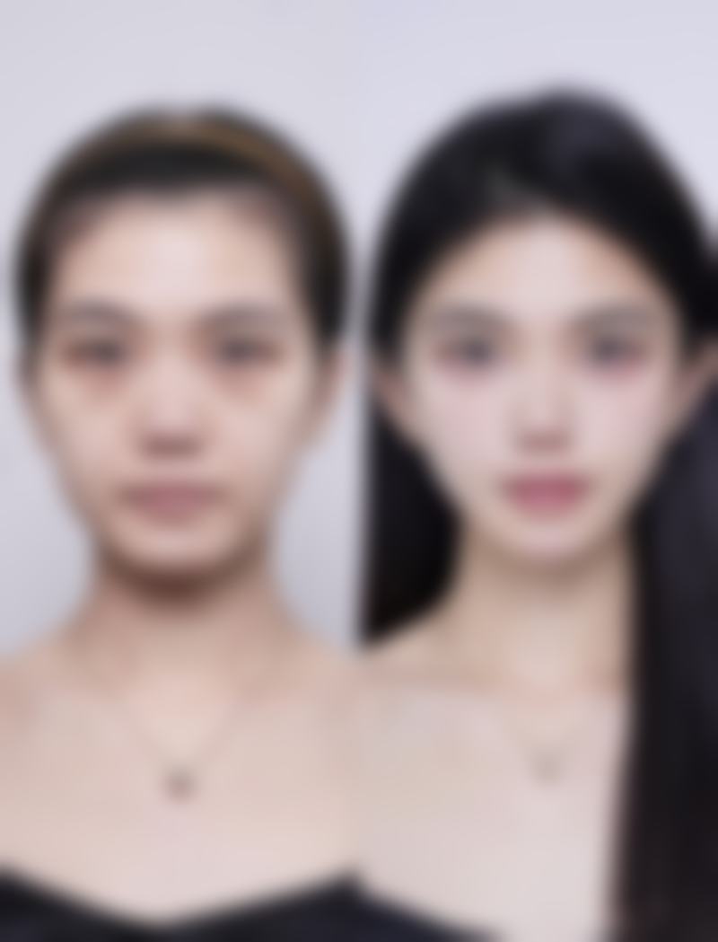 隆胸假体取出会有什么后果之心理落差