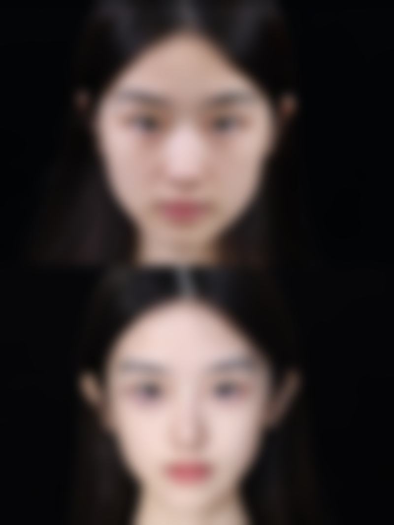 20年的凹陷性疤痕怎么消除？医院创新技术展风采