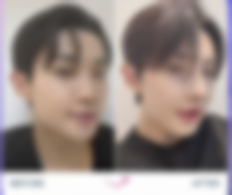 20年的增生性疤痕怎么消除？医院专精手段破难题