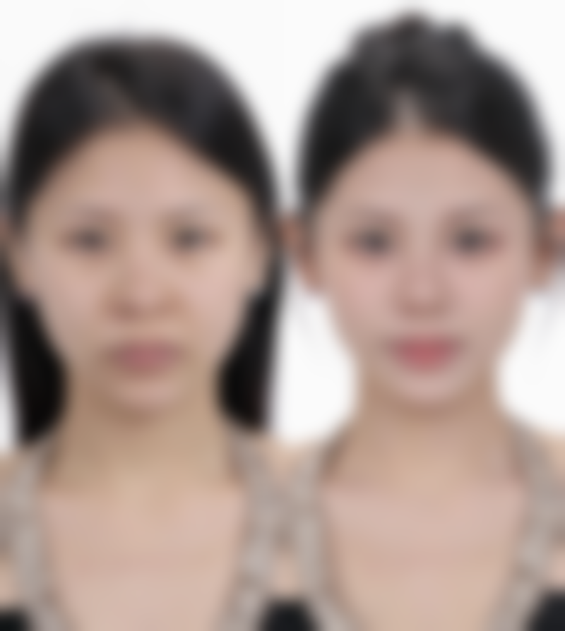 痘痘留下的疤痕怎么办：中医调理，内外兼治的“古老智慧”