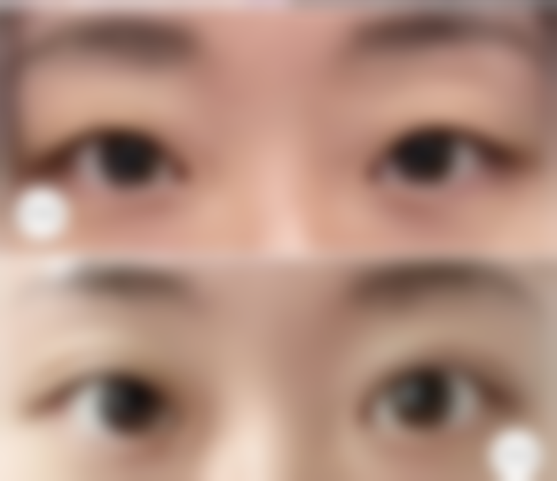 硅胶隆胸后喂奶对宝宝的影响——湖北省中医院胡霜红主事答疑