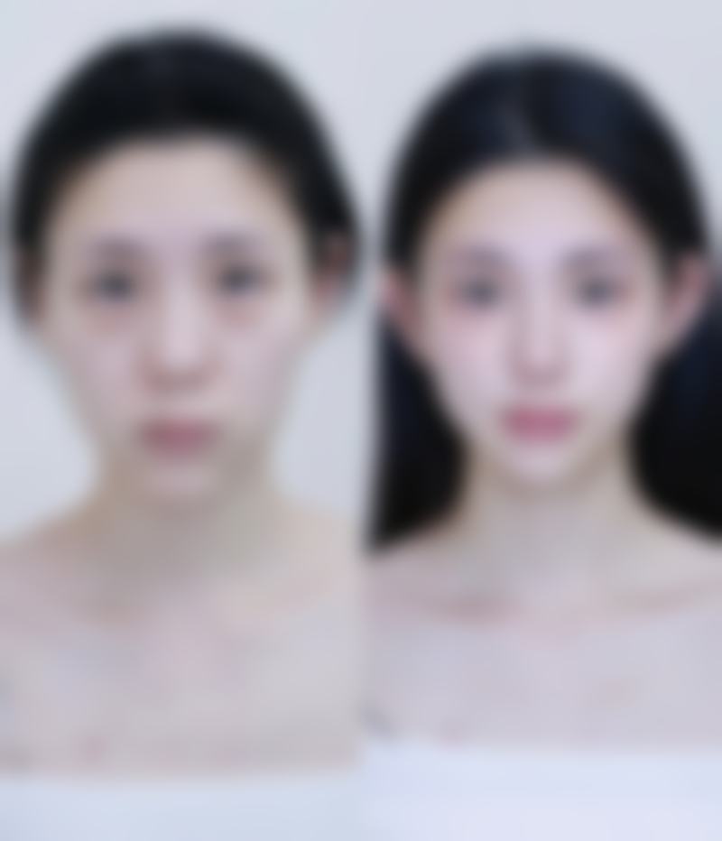 压的双眼皮太宽改窄的方法解析