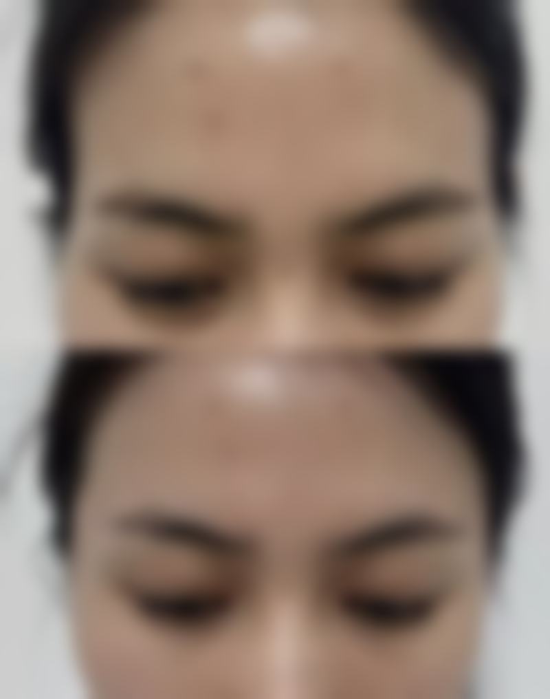 婴儿烫伤疤痕增生多久消除：加速疤痕消除的5大妙招