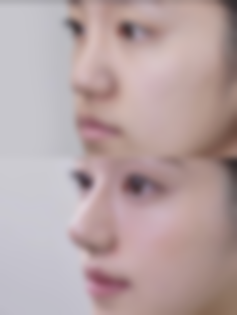 医美骨干医生揭秘双眼皮修复黄金时间