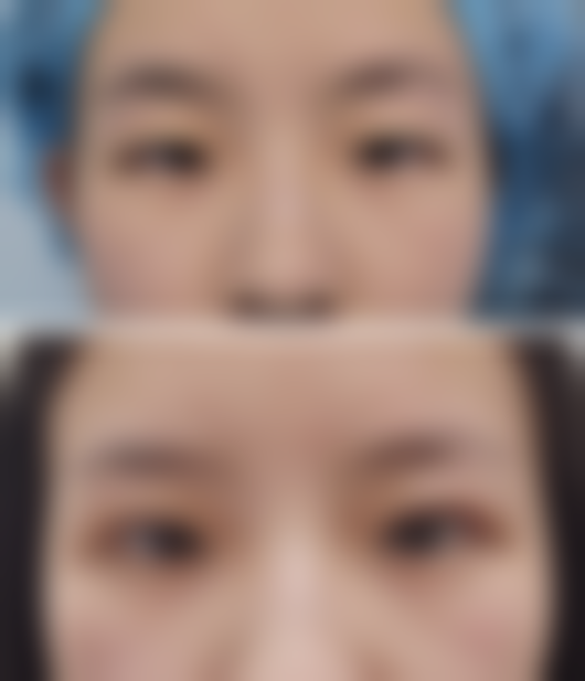 婴儿烫伤疤痕增生多久消除：什么时候需要就医