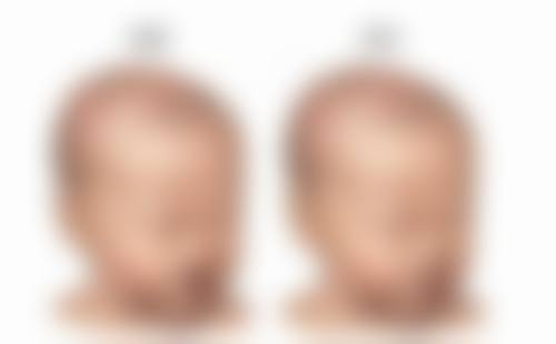 什么隆胸手术最好？内窥镜+双平面技术打造自然胸型