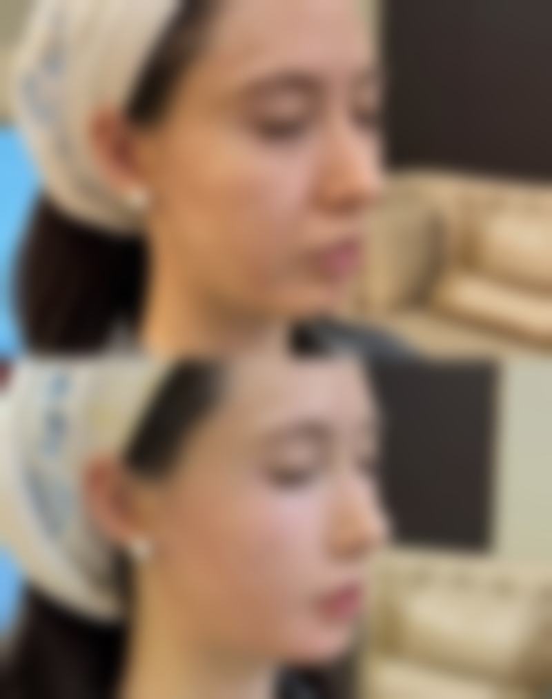 有治疗凹陷疤痕成功的吗之本地医院的实力