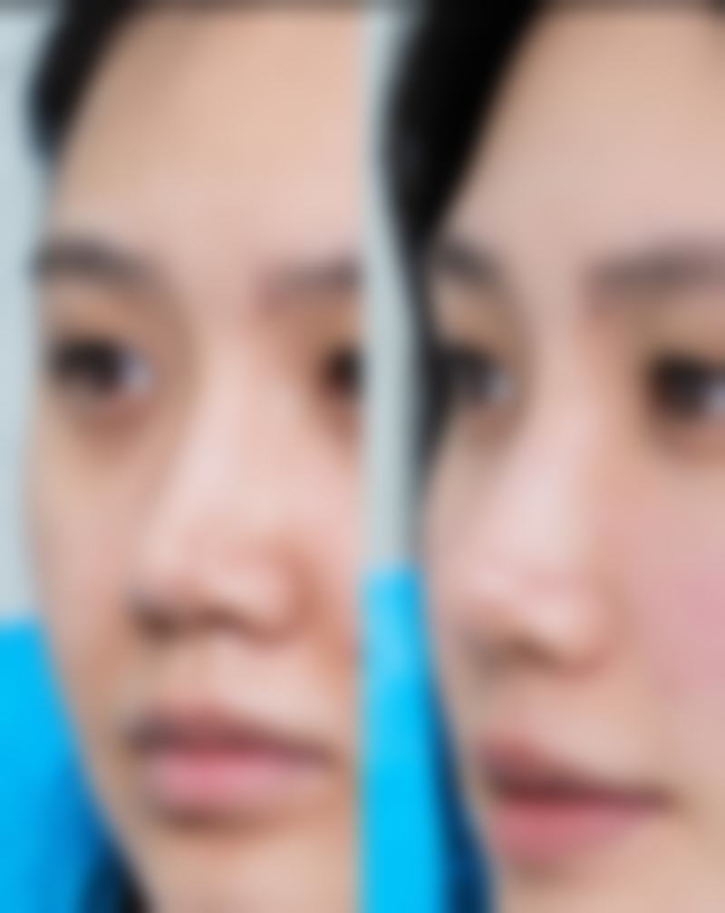 有治疗凹陷疤痕成功的吗？温县妇幼保健院李虎星团队3年眉间凹痕修复实录