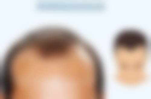 做了双眼皮以后眼皮会松弛吗？揭秘手术方式+年龄因素如何影响恢复