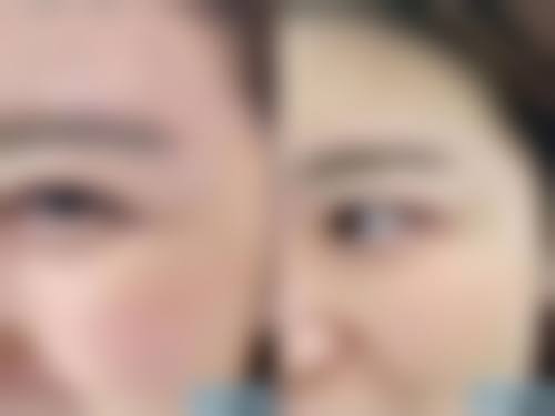 做了双眼皮以后眼皮松弛和手术方式的关系——不同方式，不同影响